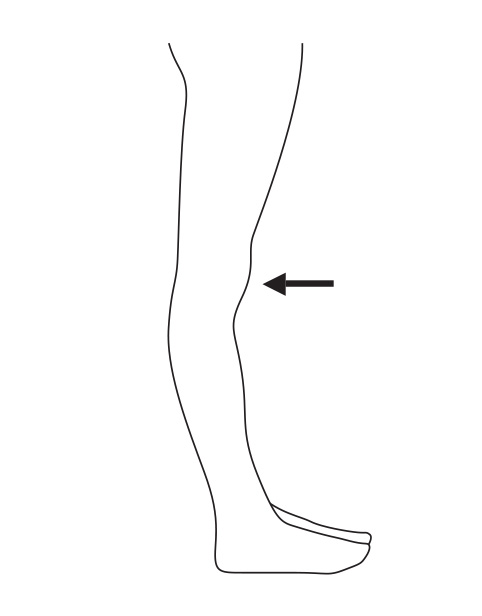 Hyperextended knee